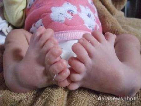 تصاویری از نوزاد 31 انگشتی در چین