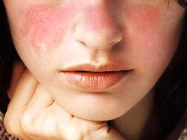 نکاتی مهم درباره یک بیماری هزارچهره که 90 درصد مبتلایانش زنان هستند